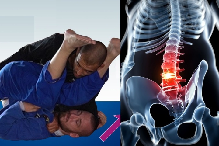 Recognizing and Managing Serious Spinal Injuries in Martial Arts Practitioners: A Focus on BJJ